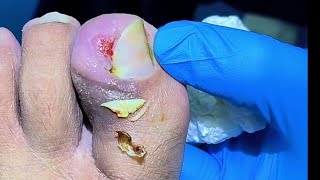 How Come This Patient Keep His Toenail So Infected Removing Huge Ingrown Toenail [upl. by Russom]