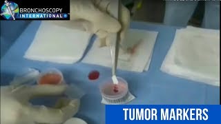 Tumor Markers and EBUS [upl. by Bordiuk290]