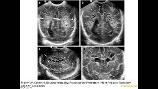 13 Periventricular leukomalacia on neonatal ultrasound white matter injury of prematurity DESHI [upl. by Chi]