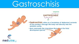 Gastroschisis Definition Causes and Diferences with Omphalocele [upl. by Noxin]