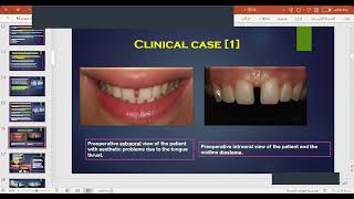 Diastema closure with direct composite restorations Prof Ahmed Mohamed Elmarakby [upl. by Chev]