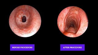 Post Tracheal reconstruction surgery Tracheal stenosis  Bronchoscopic Repair [upl. by Brigette]