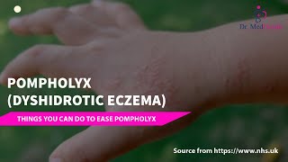 Pompholyx  Dyshidrotic eczema  dyshidrotic eczema treatment [upl. by Enyrb]