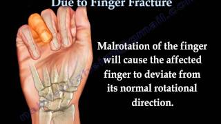 Finger Fractures Malrotation Of The Fingers  Everything You Need To Know  Dr Nabil Ebraheim [upl. by Tempest]