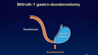 01 Billroth 1 reconstruction animation [upl. by Falcone959]