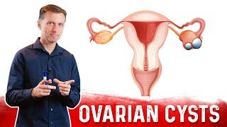 Ovarian Cysts Causes Symptoms amp Natural Treatment – DrBerg [upl. by Alorac160]