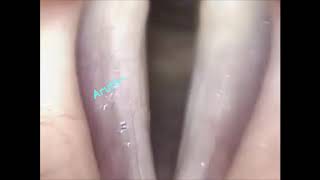 Laringoscopia  RigidezPonte Mucosa aumento em 4x da Laringe  Laryngoscopy  Rigidity  Mucous [upl. by Rasec167]