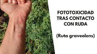 Fototoxicidad tras contacto con ruda Ruta graveolens [upl. by Jacintha787]