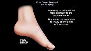 Foot Drop peroneal nerve Injury [upl. by Geoffry305]