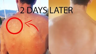 How I cured Tinea Versicolor in 2 days forever [upl. by Dulce]