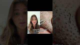 What happens when you extract your ingrown hairs with a tweezer ingrownhair ingrownhairremoval [upl. by Nairb]