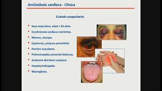 Amiloidosis Cardíaca Valoración por Medicina Nuclear  Dr Fernando Mut [upl. by Aibara319]