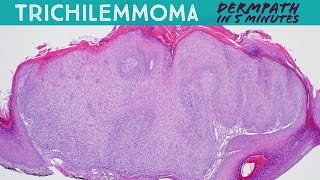 Trichilemmoma mimic of wart Dermpath in 5 Minutes dermatology pathology dermatopathology [upl. by Rehpatsirhc975]