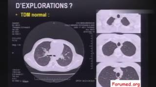 Cas Cliniques en images sur la fibrose pulmonaire idiopathique et pneumopathie [upl. by Adnac691]