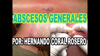 ABSCESOS GENERALES  INFECCIÓN E INFLAMACIÓN INTERNA O EN LA PIEL [upl. by Panter615]