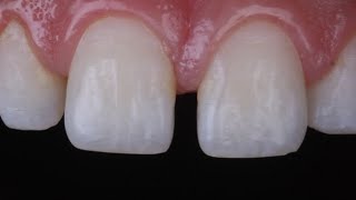 diastema closure with composite resin [upl. by Notneuq753]