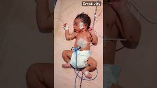 Convulsion Of Newbornmedical baby viral [upl. by Attem47]