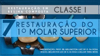 7 Restauração do Primeiro Molar Superior [upl. by Elmina]