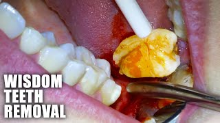 Full Wisdom Teeth Removal Procedure Emergency Extraction of Impacted amp Partially Erupted Molar [upl. by Hadley]