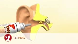 How to use Otex Ear Drops [upl. by Ettenom]