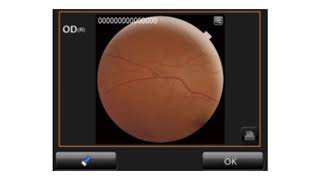 Peripheral Fundus Photography on the TRC NW400 [upl. by Anidan]