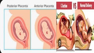 which type of placenta is good for normal delivery Sandhyavlogyk7zj [upl. by Rasec]