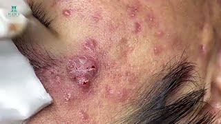 Big Cystic Acne Blackheads Extraction Blackheads amp Milia Whiteheads Removal Pimple Popping [upl. by Minnaminnie]