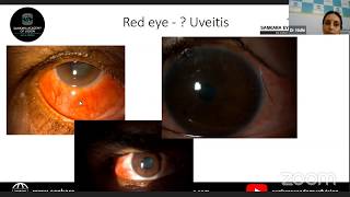 Anterior Uveitis Case Based LiveStream Lecture Series LetsGetonwithExams [upl. by Atteynad]