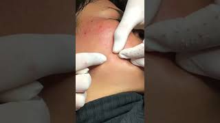 Best Pimple Popping 20 cute reels facts fashion beautiful blackheads sacdepspa hindi [upl. by Ahsiugal965]