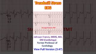 Treadmill Stress ECG [upl. by Fording]