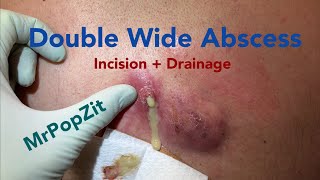 The double wide double pop giant abscess Multiple pockets and sinus tracts expressed and cleared [upl. by Adamek]