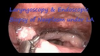 Laryngoscopy amp Endoscopic Biopsy of Neoplasm under LA [upl. by Jay]