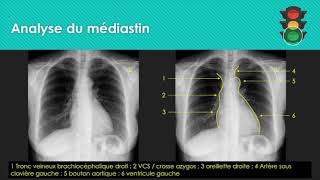 M1 Analyse de la radiographie thoracique médiastin [upl. by Shapiro]