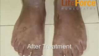 Treatment Lichen Planus on Hands amp Feet Before After Treatment Photos [upl. by Ikkir]