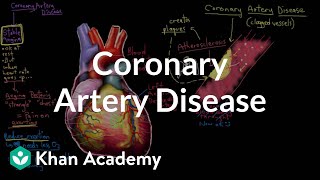 What is coronary artery disease  Circulatory System and Disease  NCLEXRN  Khan Academy [upl. by Yngiram934]