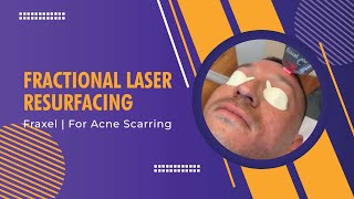 Fractional Laser Resurfacing  Fraxel  For Acne Scarring  Dr Jason Emer [upl. by Bonnes]