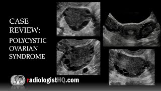 Ultrasound of Polycystic Ovarian Syndrome [upl. by Olinad]