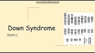 Trisomy 21 Down syn Genetics Pathology Clinical Symptoms and Diagnosis [upl. by Navoj]