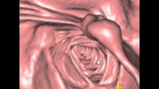 virtual colon Lipomatous hypertrophy ileocecal valve CASE65Davi [upl. by Nicole817]