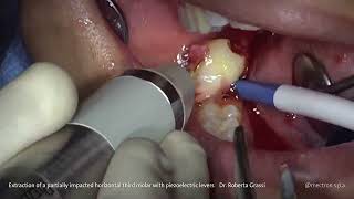 PIEZOSURGERY®  Dr Roberta Grassi Extraction of Impacted Third Molar with Piezo Levers [upl. by Engenia370]