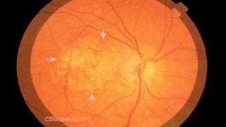 Macular Degeneration and the Aging Retina [upl. by Etsirhc627]