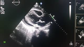 effuso constrictive pericarditis echocardiography [upl. by Aylmar]