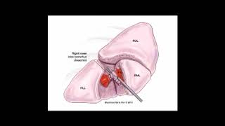 STS University 2018  Course 6 VATS Lobectomy [upl. by Estrin]