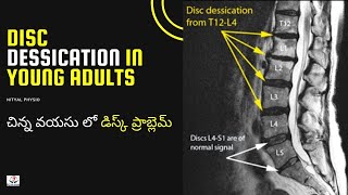 Disc Degeneration L5 S1 Disc Desiccation Disc Degeneration Causes DDDDegenerative Disc Treatment [upl. by Rawlinson217]