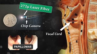 Laser Treatment of Laryngeal Papillomas RRP [upl. by Nlyak522]