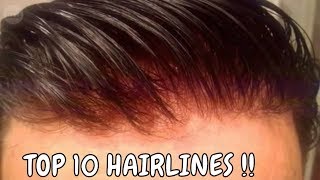 HAIR REPLACEMENT TOP 10 BEST HAIRLINES [upl. by Leonie]