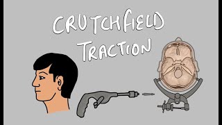 How to apply Cervical traction  Crutchfield Traction [upl. by Nnairrehs66]