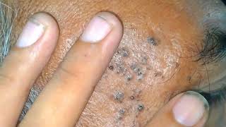 certifying relax sac dep spa face treatments 2023  skin cyst treatment 2023  sac dep spa New video [upl. by Lavery]