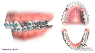 Orthodontic Treatment for Overjet Overbite  Removing 2 Upper Premolars [upl. by Oramug]