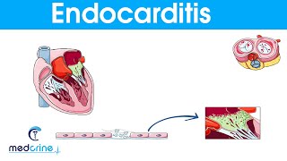 Endocarditis  causes symptoms pathophysiology diagnosis and treatment [upl. by Araic]